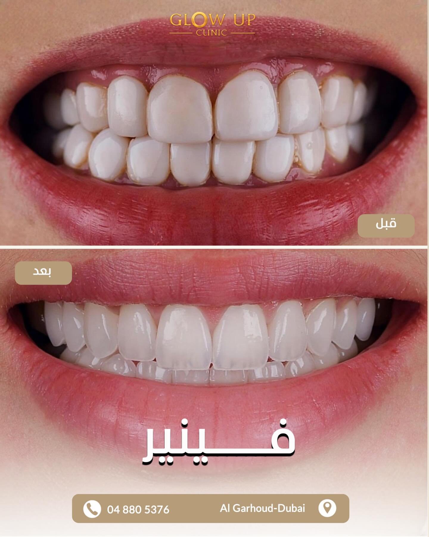 ابتسامة هوليوود - قبل وبعد - عيادة جلو أب